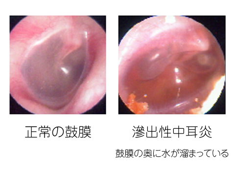 かつの耳鼻咽喉科 正常な鼓膜と滲出性中耳炎（鼓膜の奥に水が溜まっている）