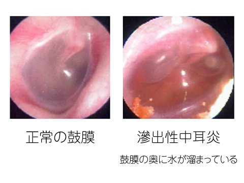 水 抜け ない 耳 耳の水が抜けないまま2日！ずっとゴロゴロするときの対処法