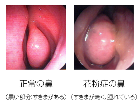 痛い 鼻 が の 中 鼻が痛い・鼻の奥が痛い原因と治療法｜大阪和泉市の老木医院